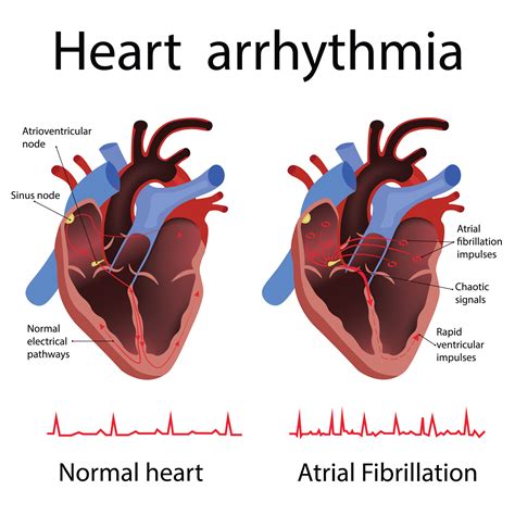 arrhythmia heart failure